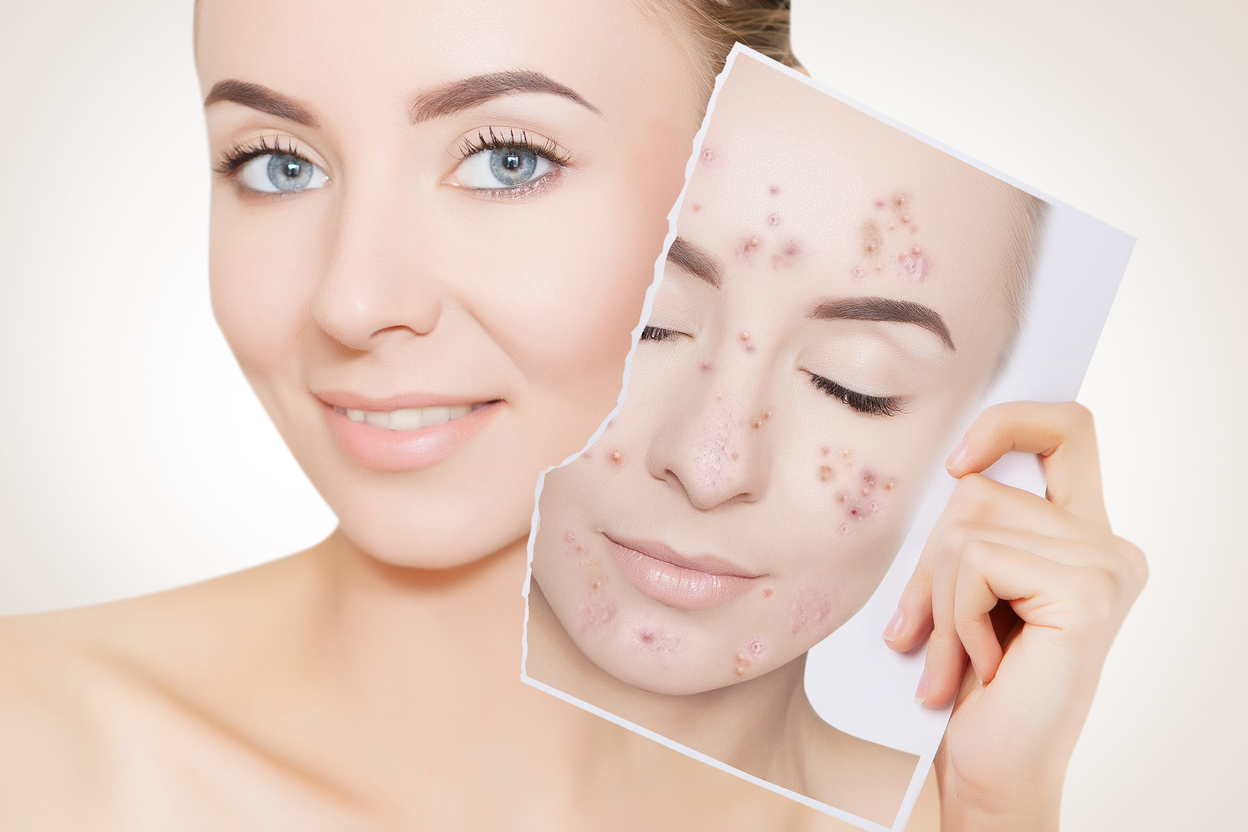 European Skin Care and Spa Asheville Acne Clinic Program